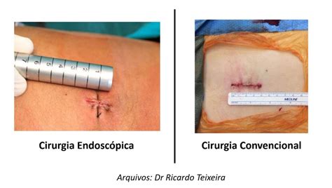 Ventral Slot Cirurgia De Recuperacao